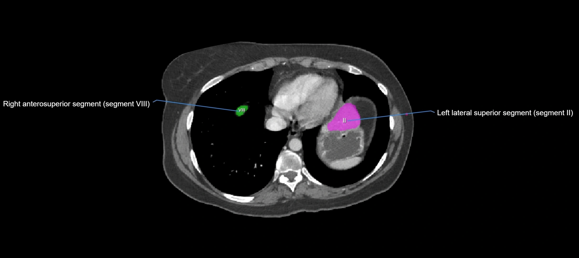 CT liver segments axial cross sectional anatomy labelled image-00076.webp